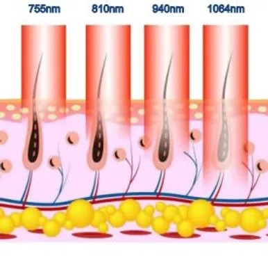 De 4 dieptes van de 4-wave laser